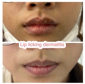 ผิวหนังอักเสบรอบปาก ผื่นแดงรอบปาก Lip licking dermatitis คืออะไร สาเหตุ อาการ การรักษา