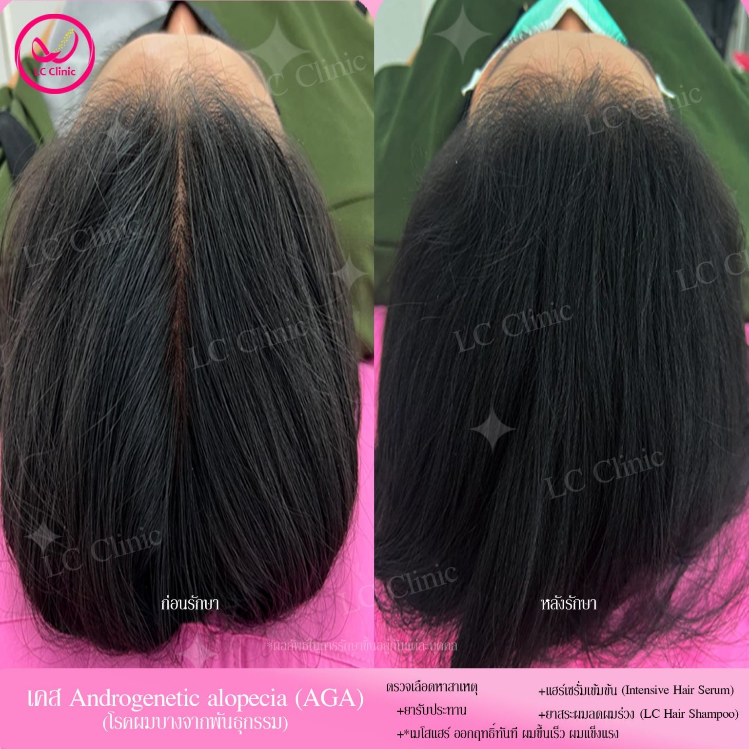 เมโสแฮร์ Meso Hair คืออะไร ยับยั้งผมร่วง ช่วยให้ผมขึ้นใหม่ บำรุงรากผม ได้ยังไง