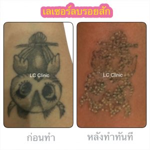 เลเซอร์ลบรอยสัก ดียังไง การเตรียมตัว ขั้นตอนการทำ รีวิวก่อนและหลังทำ