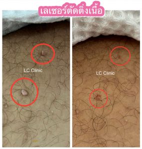 ติ่งเนื้อ acrochordon skin tag คืออะไร อันตรายไหม รีวิว เลเซอร์ ตัดติ่งเนื้อ ทำยังไง การดูแลหลังทำ