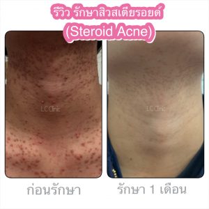 สิวสเตียรอยด์ Steroid Acne ตืออะไร สาเหตุ อาการ การรักษา