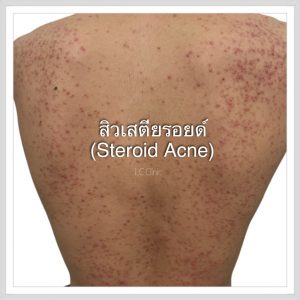 สิวสเตียรอยด์ Steroid Acne ตืออะไร สาเหตุ อาการ การรักษา