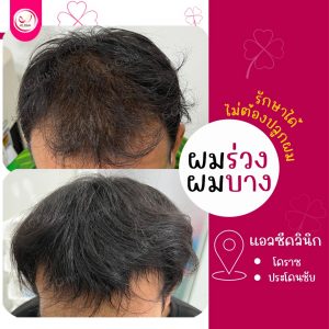 Finasteride ฟีนาสเตอร์ไรด์ ยากิน รักษา ผมร่วง คืออะไร วิธีใช้ ผลข้างเคียง