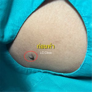 ติ่งเนื้อ acrochordon skin tag คืออะไร อันตรายไหม รีวิว เลเซอร์ ตัดติ่งเนื้อ ทำยังไง การดูแลหลังทำ