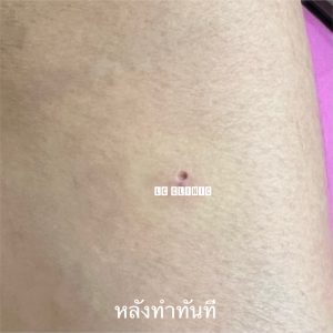 เลเซอร์ไฝ คืออะไร ดียังไง การดูแลหลังทำ เลเซอร์ไฝ โคราช บุรีรัมย์