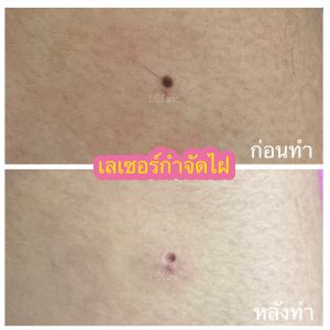 เลเซอร์ไฝ คืออะไร ดียังไง การดูแลหลังทำ เลเซอร์ไฝ โคราช บุรีรัมย์