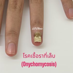 โรคเชื้อราที่เล็บ รักษา เชื้อราที่เล็บ Onychomycosis ทำยังไง ยากิน ยาทา โคราช บุรีรัมย์