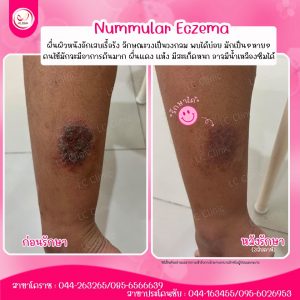 ผื่นรูปเหรียญ โรคผิวหนังอักเสบวงกลม nummular eczema คืออะไร สาเหตุ อาการ รักษา